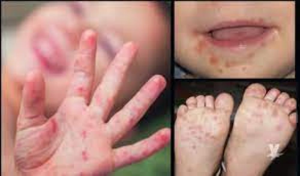 Virus coxsackie en niños qué es y cómo se contagia